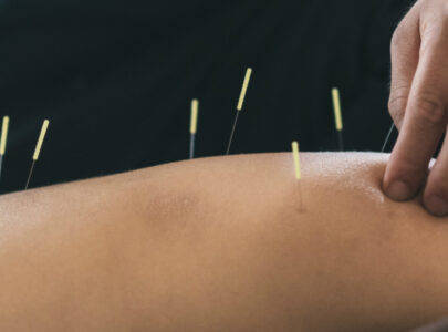 Acupuncture for Mental Health