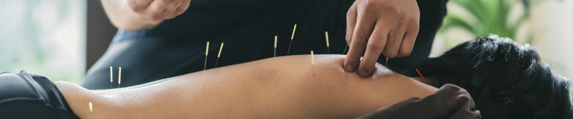 Acupuncture for Mental Health